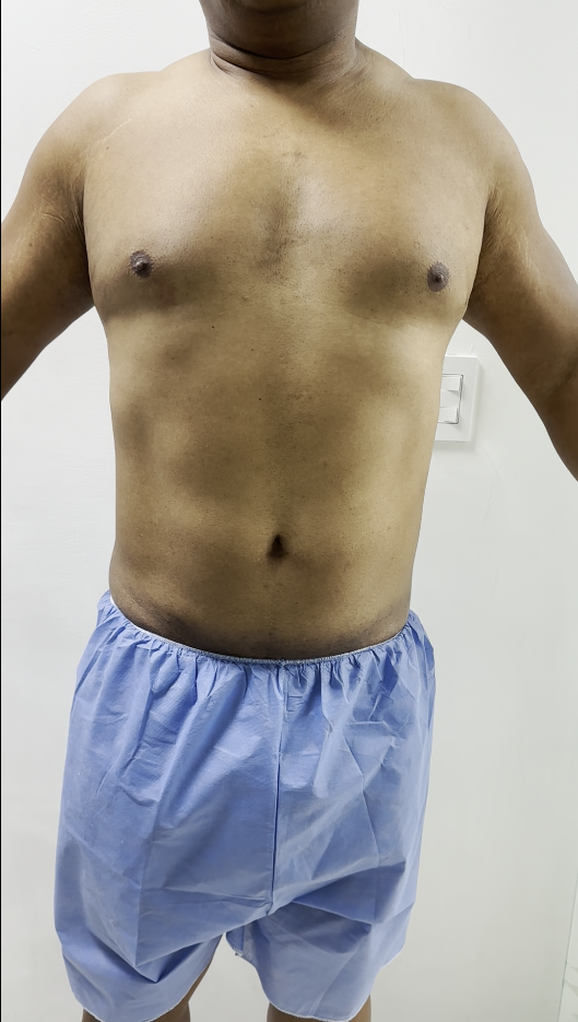 Antes — Remodelación corporal masculina con tecnología láser y ultrasonido