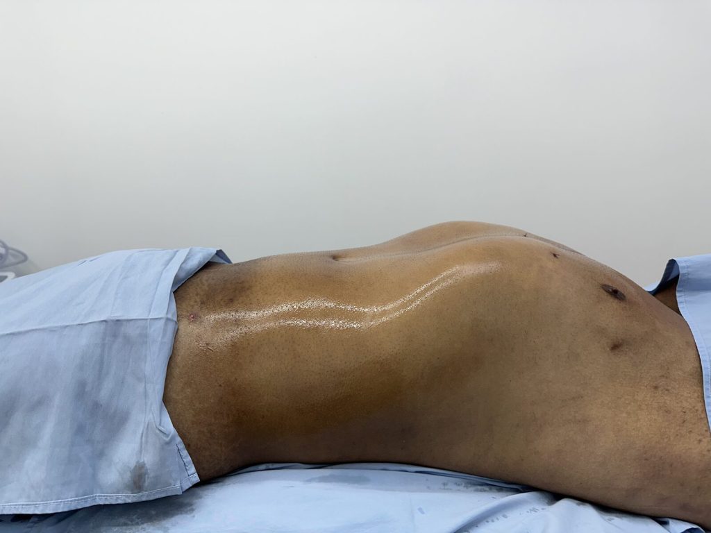 Después — Remodelación corporal masculina con tecnología láser y ultrasonido