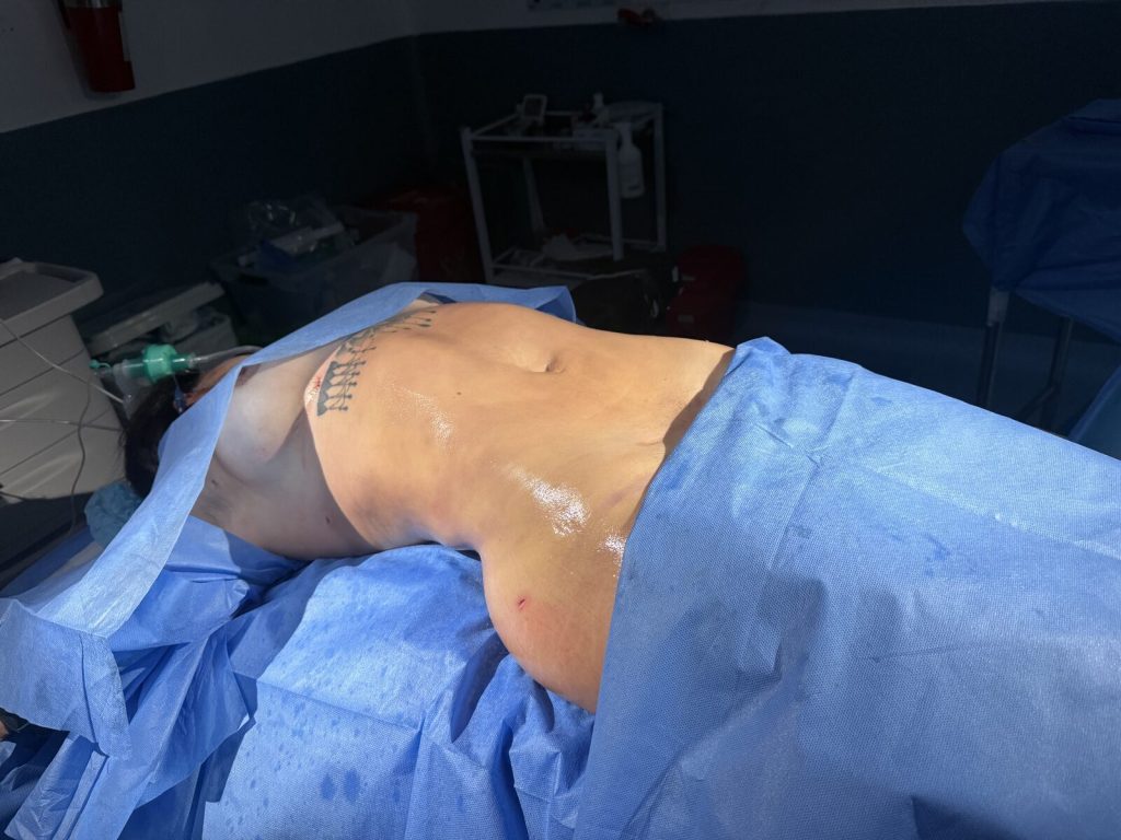 Después — Cuando la tecnología permite evitar una abdominoplastia